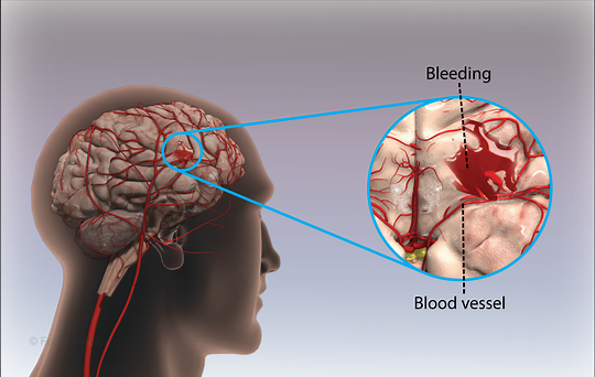 Bleeding blood vessels in the brain